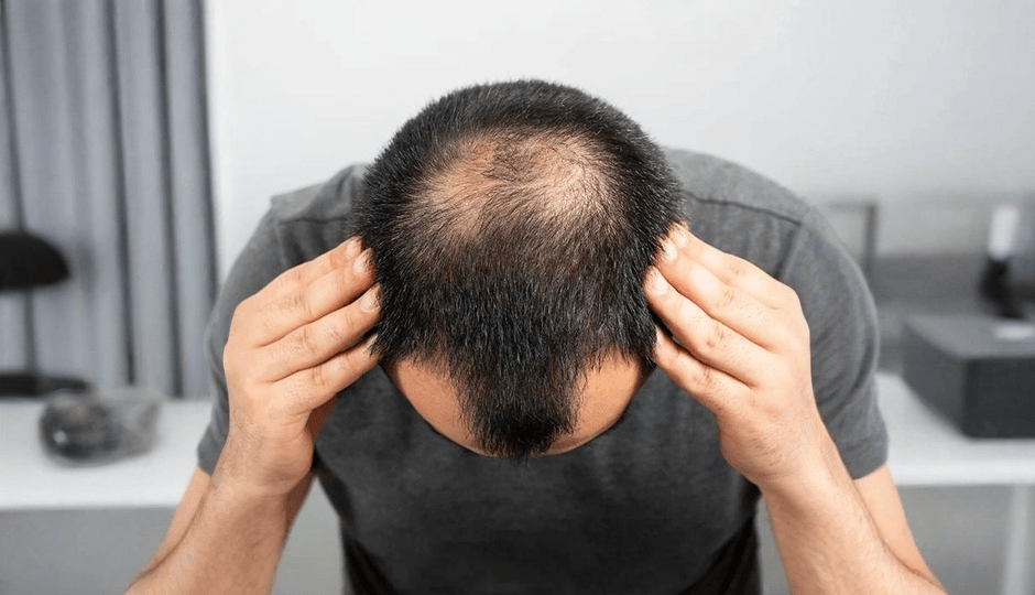 How to Prevent Hair Loss In Men?