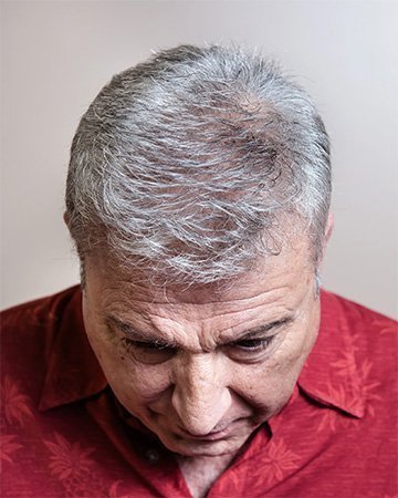 01 mens hair loss solutions before and after 01 solutions before after mens gallery 01 mens hair loss solutions before and after 01