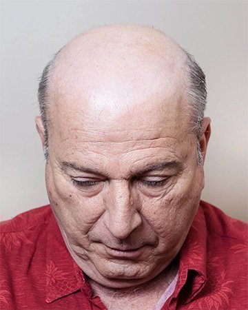 01 mens hair loss solutions before and after 02 solutions before after mens gallery 01 mens hair loss solutions before and after 02