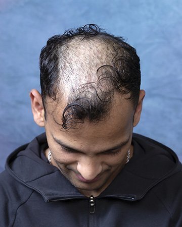 04 mens hair loss solutions before and after 02 solutions before after mens gallery 04 mens hair loss solutions before and after 02