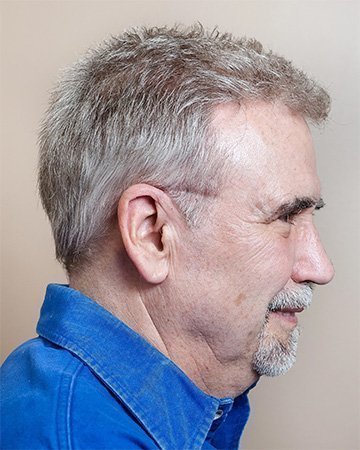 05 mens hair loss solutions before and after 01 solutions before after mens gallery 05 mens hair loss solutions before and after 01