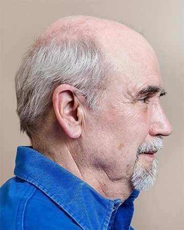 05 mens hair loss solutions before and after 02 solutions before after mens gallery 05 mens hair loss solutions before and after 02