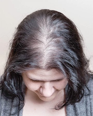   solutions before after womens gallery 01 womens hair systems before and after 02