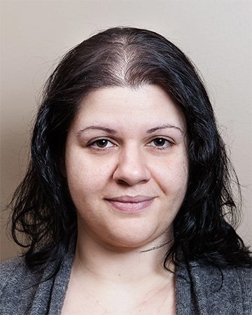   solutions before after womens gallery 02 womens hair loss solutions before and after 02